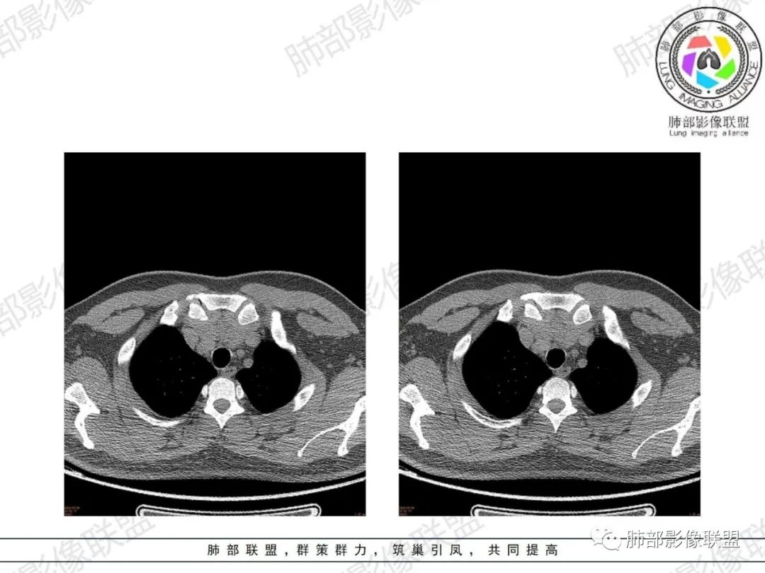 影像PPT - 【病例】胸腺增生1例CT影像讨论-5 影像PPT - 【病例】胸腺增生1例CT影像讨论-5