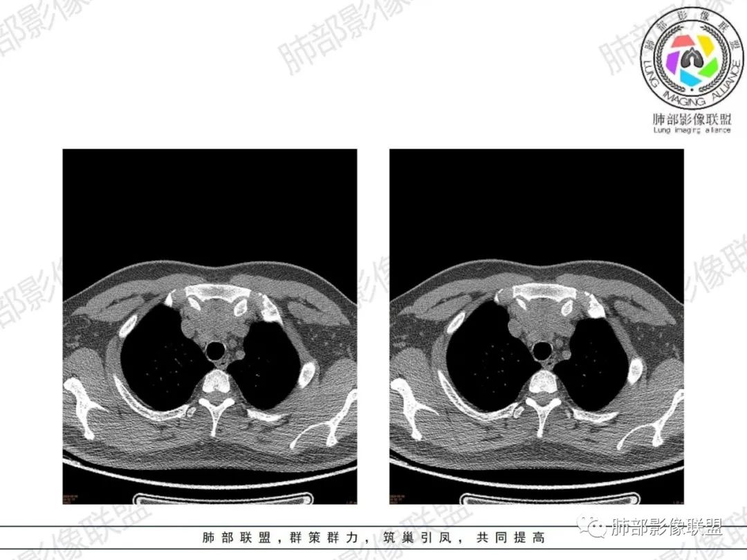 影像PPT - 【病例】胸腺增生1例CT影像讨论-6 影像PPT - 【病例】胸腺增生1例CT影像讨论-6