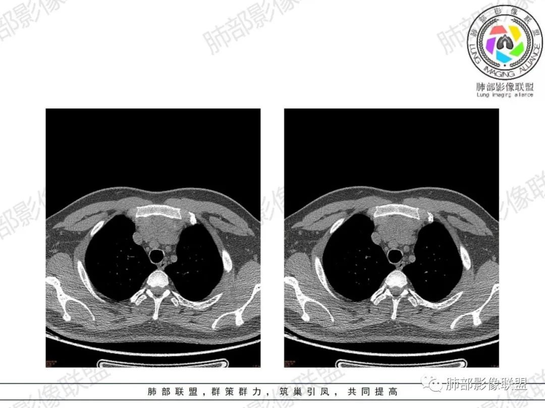 影像PPT - 【病例】胸腺增生1例CT影像讨论-7 影像PPT - 【病例】胸腺增生1例CT影像讨论-7