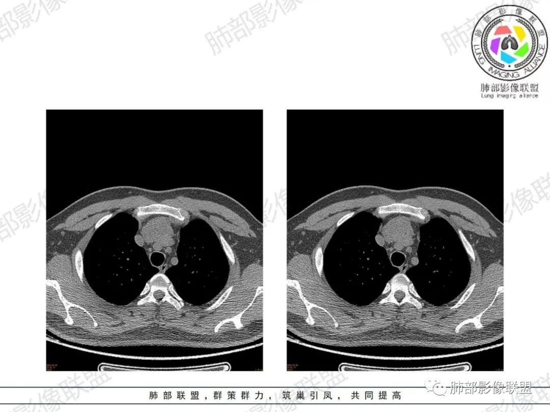 影像PPT - 【病例】胸腺增生1例CT影像讨论-8 影像PPT - 【病例】胸腺增生1例CT影像讨论-8