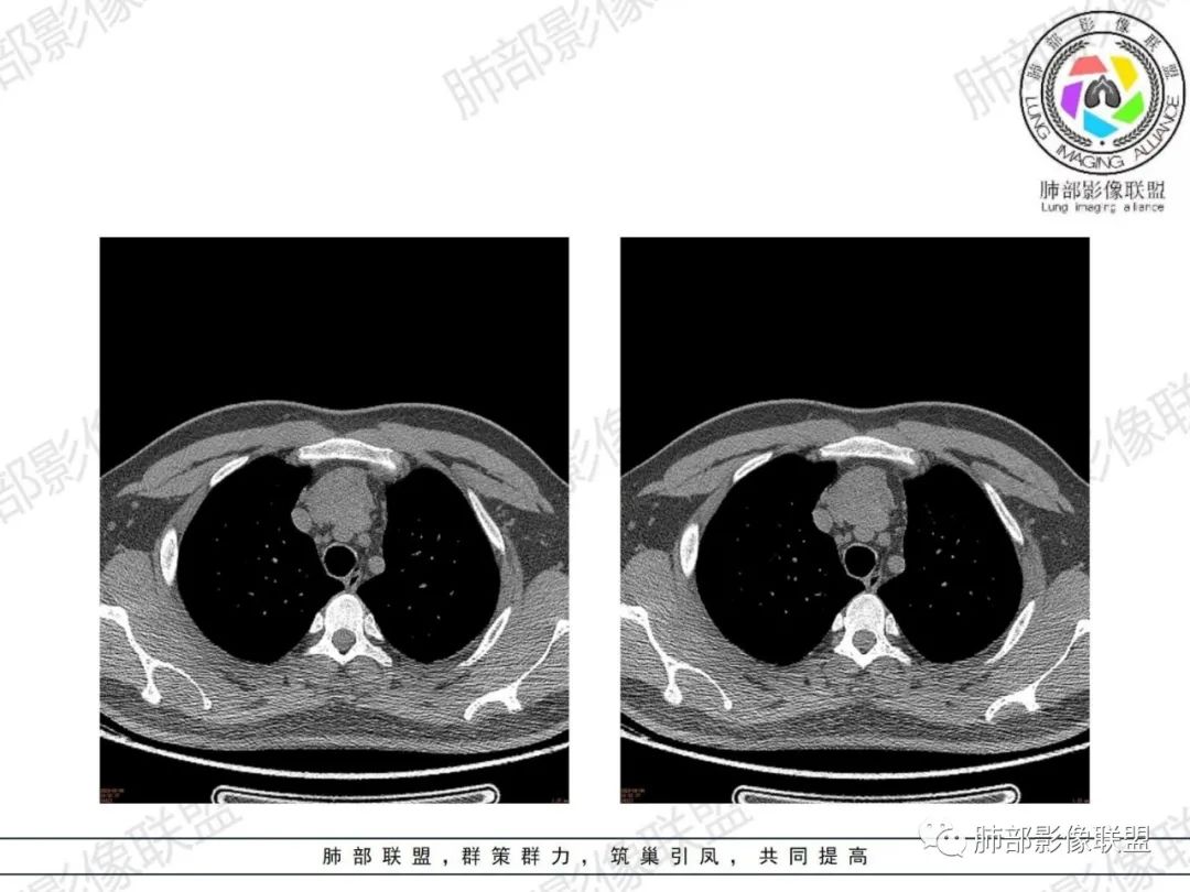 影像PPT - 【病例】胸腺增生1例CT影像讨论-9 影像PPT - 【病例】胸腺增生1例CT影像讨论-9