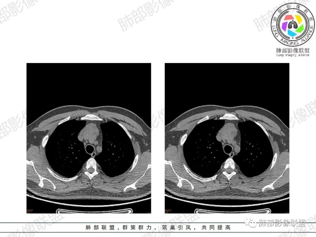 影像PPT - 【病例】胸腺增生1例CT影像讨论-10 影像PPT - 【病例】胸腺增生1例CT影像讨论-10