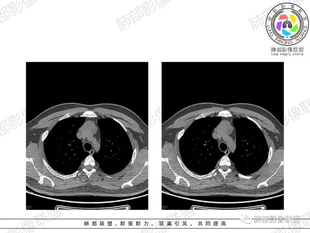 影像PPT - 【病例】胸腺增生1例CT影像讨论-11 影像PPT - 【病例】胸腺增生1例CT影像讨论-11