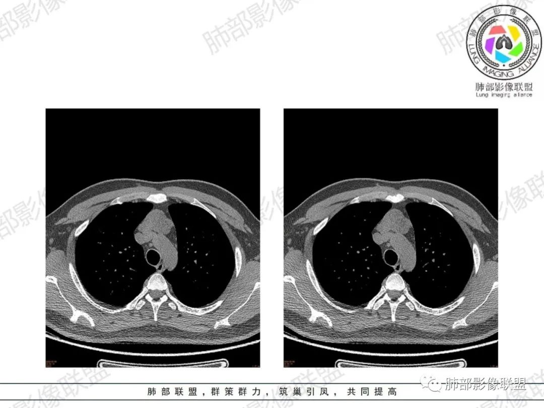 影像PPT - 【病例】胸腺增生1例CT影像讨论-12 影像PPT - 【病例】胸腺增生1例CT影像讨论-12