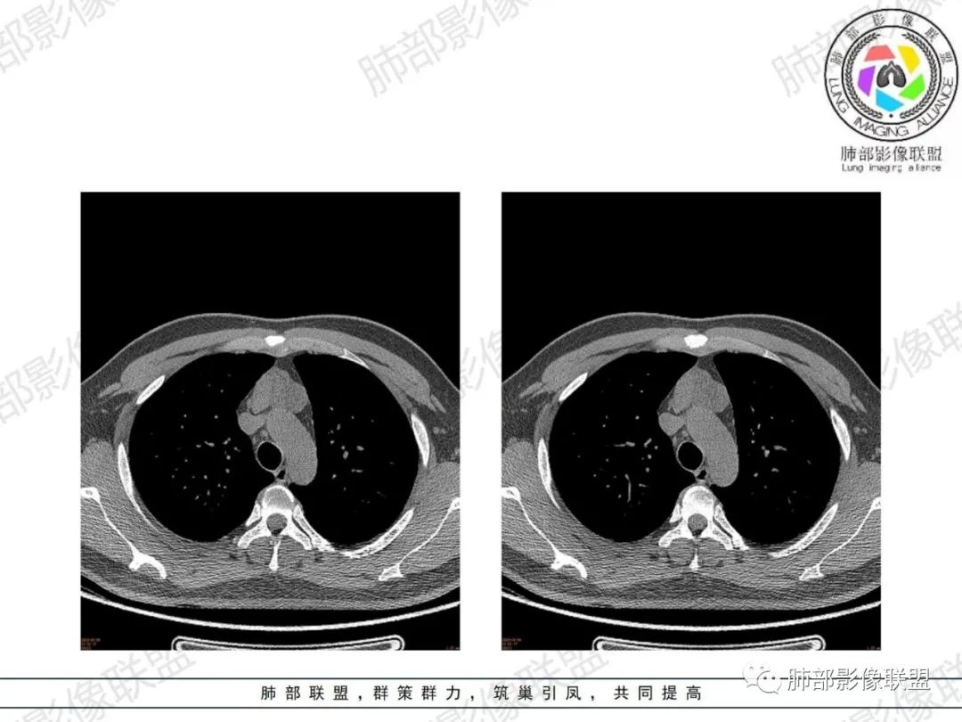 影像PPT - 【病例】胸腺增生1例CT影像讨论-13 影像PPT - 【病例】胸腺增生1例CT影像讨论-13