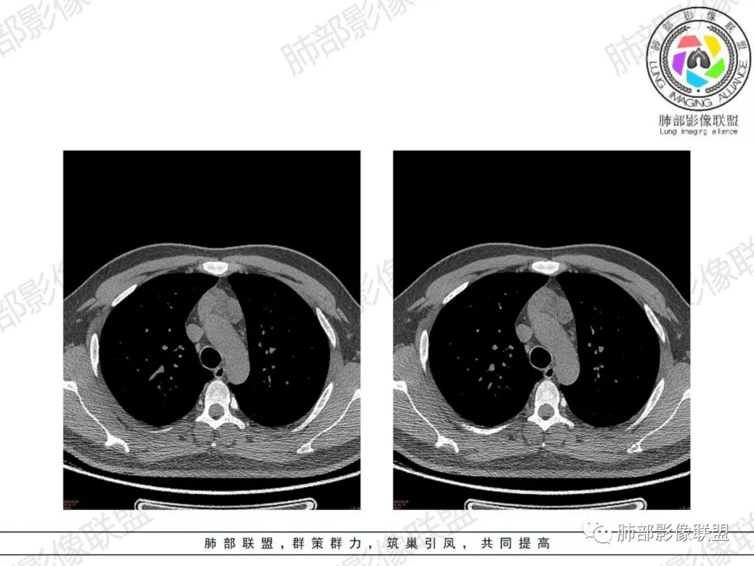 影像PPT - 【病例】胸腺增生1例CT影像讨论-14 影像PPT - 【病例】胸腺增生1例CT影像讨论-14