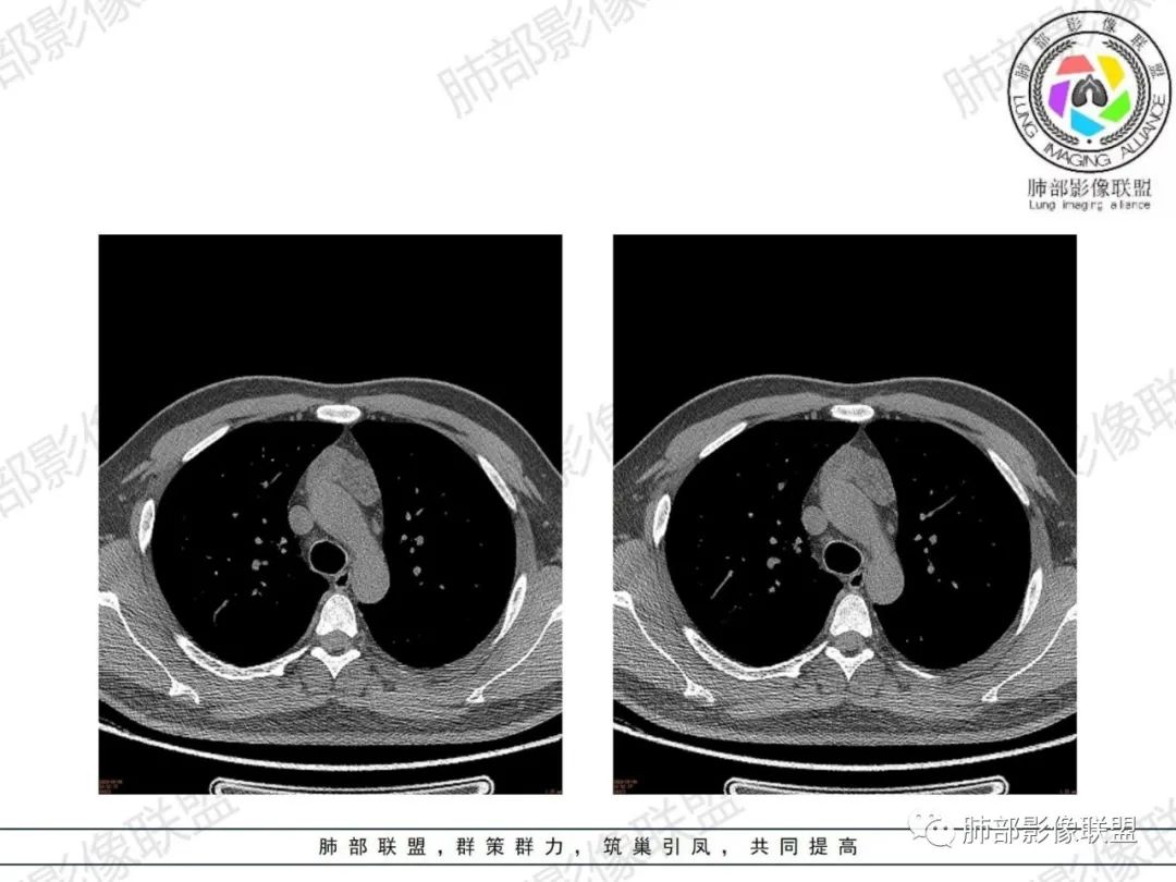 影像PPT - 【病例】胸腺增生1例CT影像讨论-15 影像PPT - 【病例】胸腺增生1例CT影像讨论-15