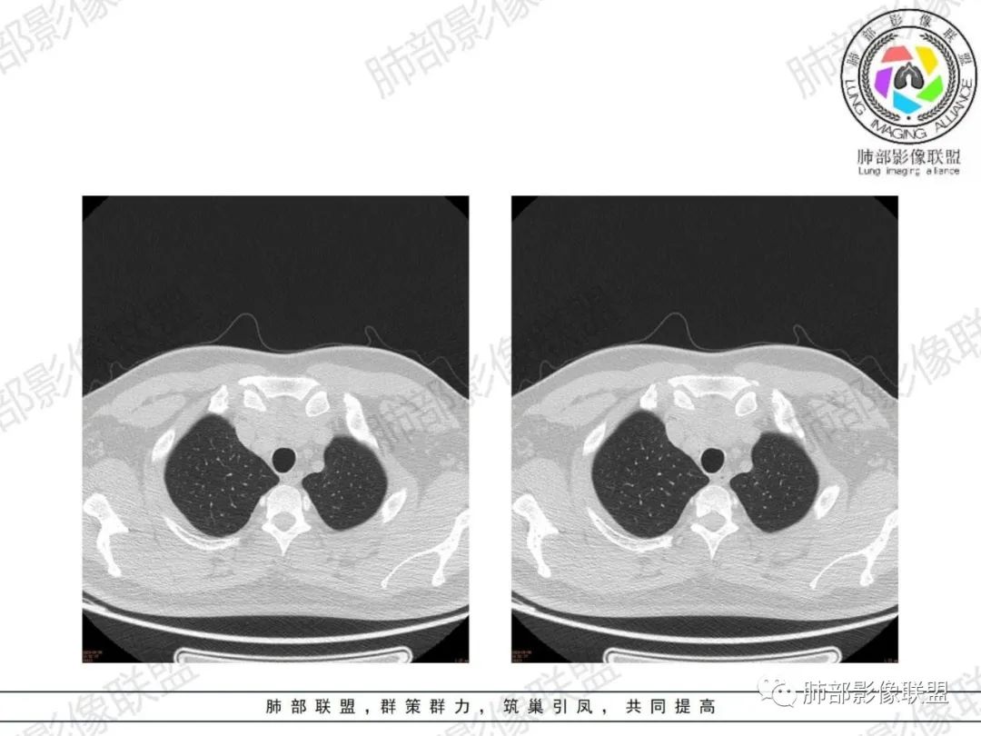 影像PPT - 【病例】胸腺增生1例CT影像讨论-21 影像PPT - 【病例】胸腺增生1例CT影像讨论-21