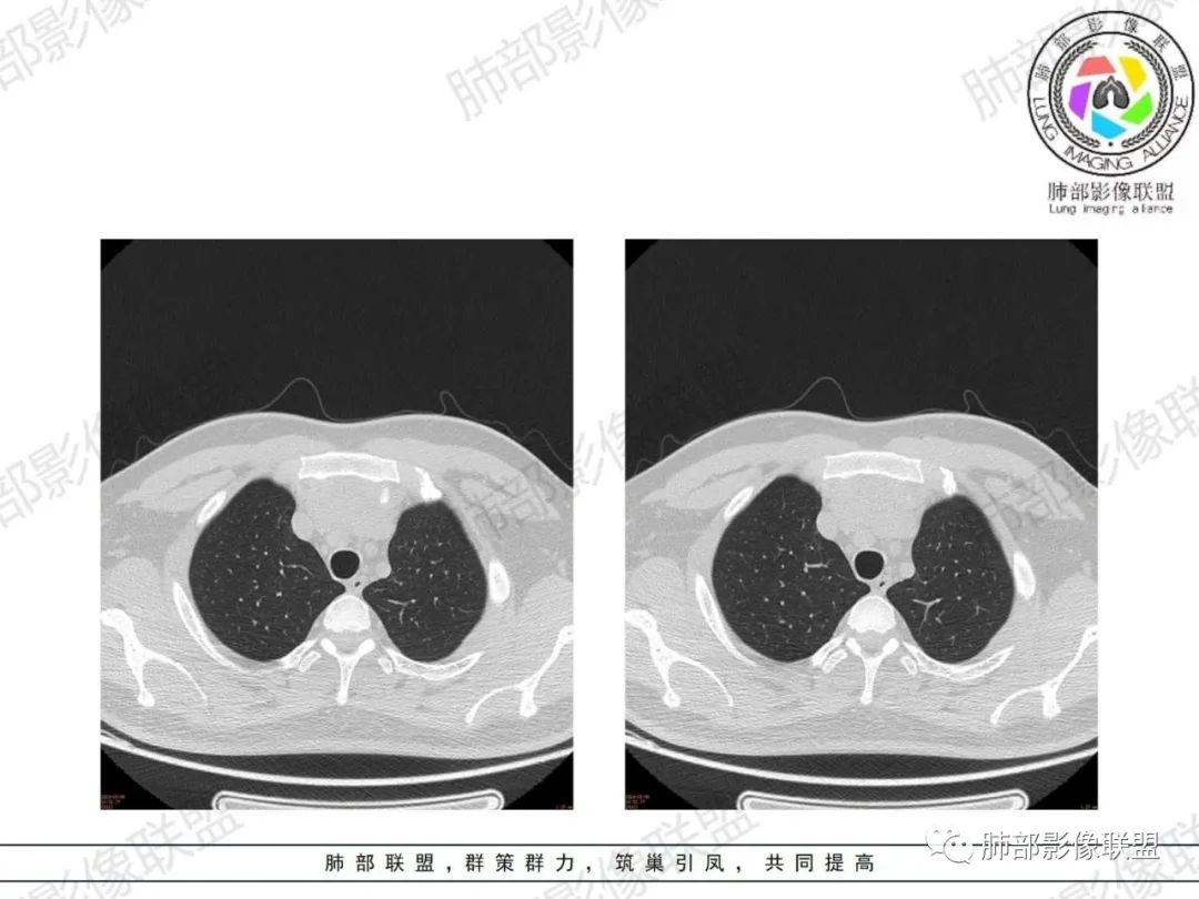 影像PPT - 【病例】胸腺增生1例CT影像讨论-22 影像PPT - 【病例】胸腺增生1例CT影像讨论-22
