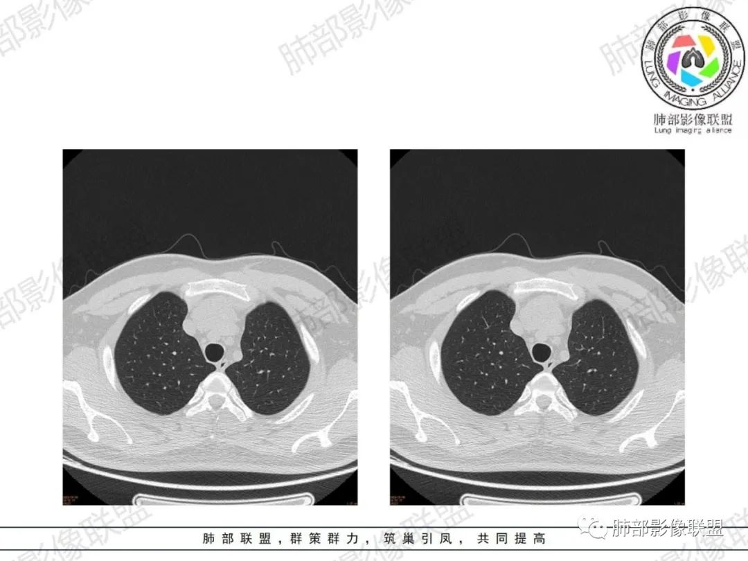 影像PPT - 【病例】胸腺增生1例CT影像讨论-23 影像PPT - 【病例】胸腺增生1例CT影像讨论-23