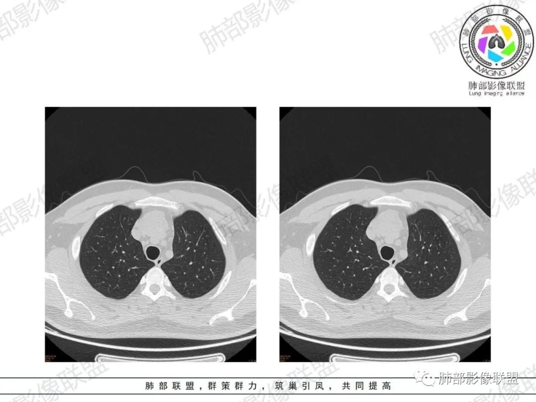 影像PPT - 【病例】胸腺增生1例CT影像讨论-24 影像PPT - 【病例】胸腺增生1例CT影像讨论-24