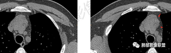 影像PPT - 【病例】胸腺增生1例CT影像讨论-28 影像PPT - 【病例】胸腺增生1例CT影像讨论-28