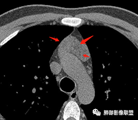 影像PPT - 【病例】胸腺增生1例CT影像讨论-32 影像PPT - 【病例】胸腺增生1例CT影像讨论-32