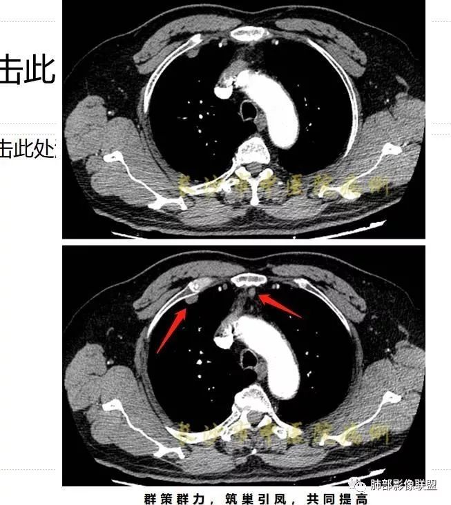 影像PPT - 【病例】胸腺癌1例CT影像讨论-21 影像PPT - 【病例】胸腺癌1例CT影像讨论-21