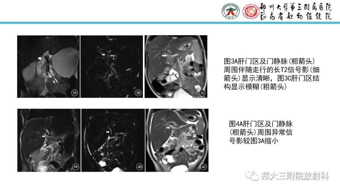 影像PPT - 【PPT】胆道闭锁的影像表现-12
