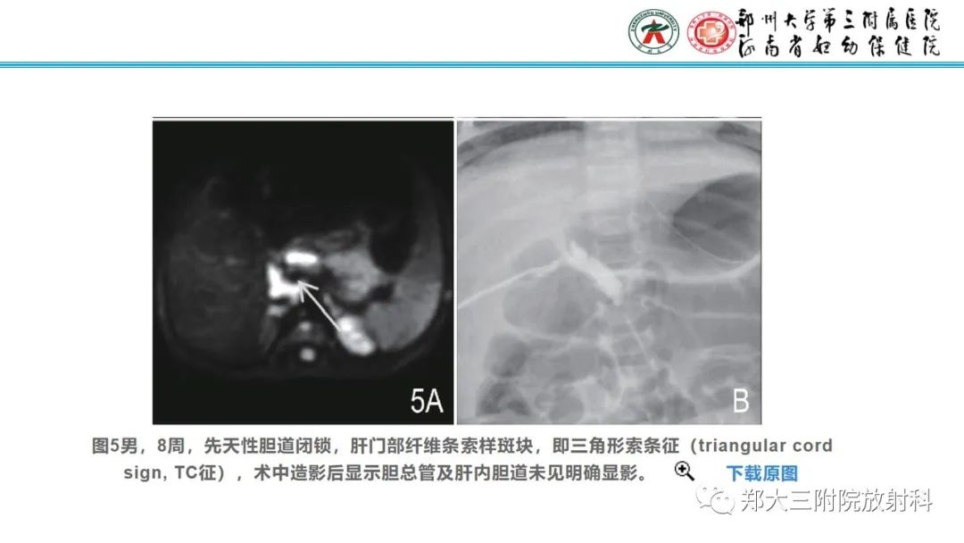 影像PPT - 【PPT】胆道闭锁的影像表现-16