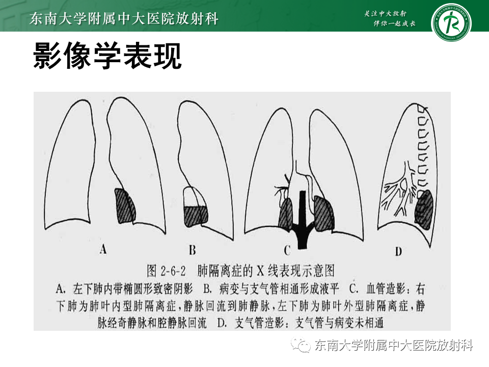 影像PPT - 【PPT】肺隔离症-8
