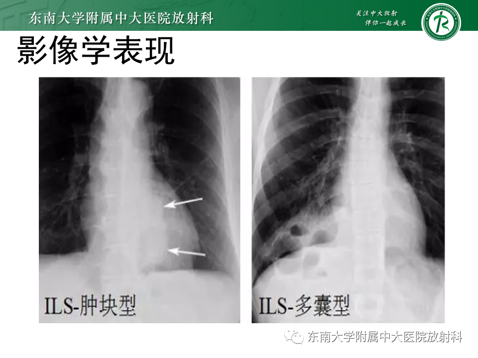 影像PPT - 【PPT】肺隔离症-9