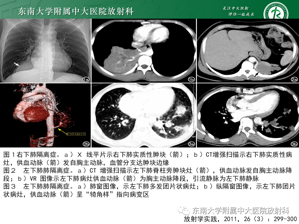 影像PPT - 【PPT】肺隔离症-11
