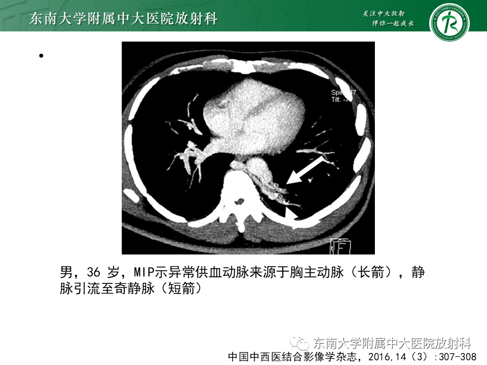 影像PPT - 【PPT】肺隔离症-12