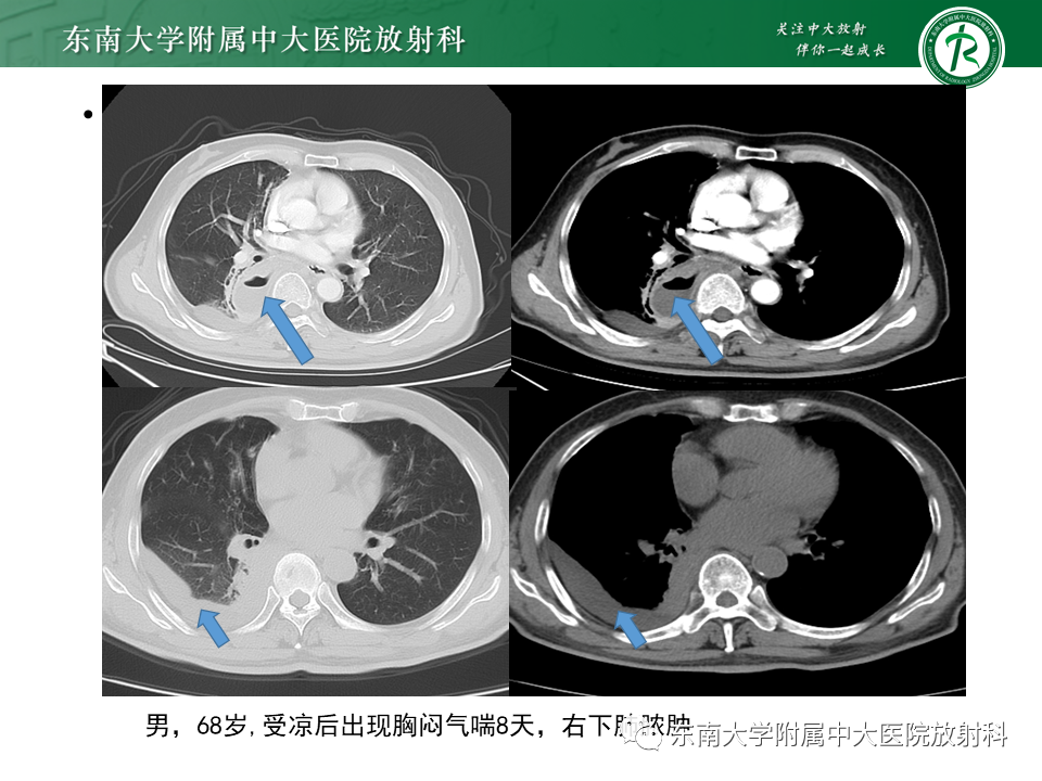 影像PPT - 【PPT】肺隔离症-15