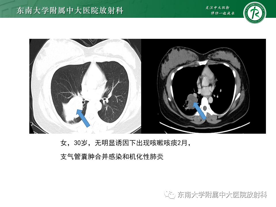影像PPT - 【PPT】肺隔离症-17