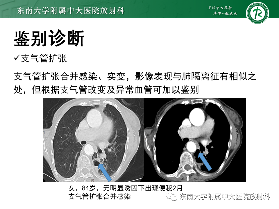影像PPT - 【PPT】肺隔离症-18