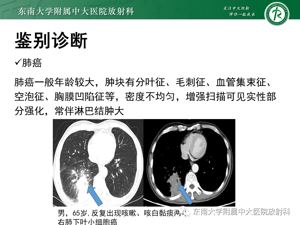 影像PPT - 【PPT】肺隔离症-19