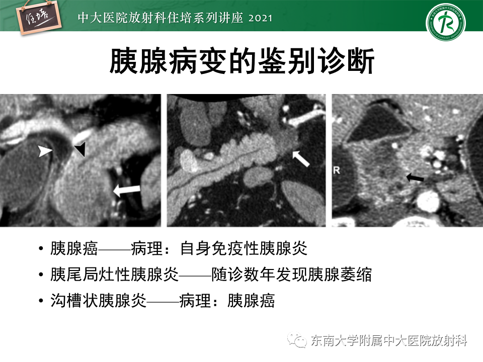 影像PPT - 【PPT】胰腺导管腺癌的影像诊断、评估及鉴别诊断-3
