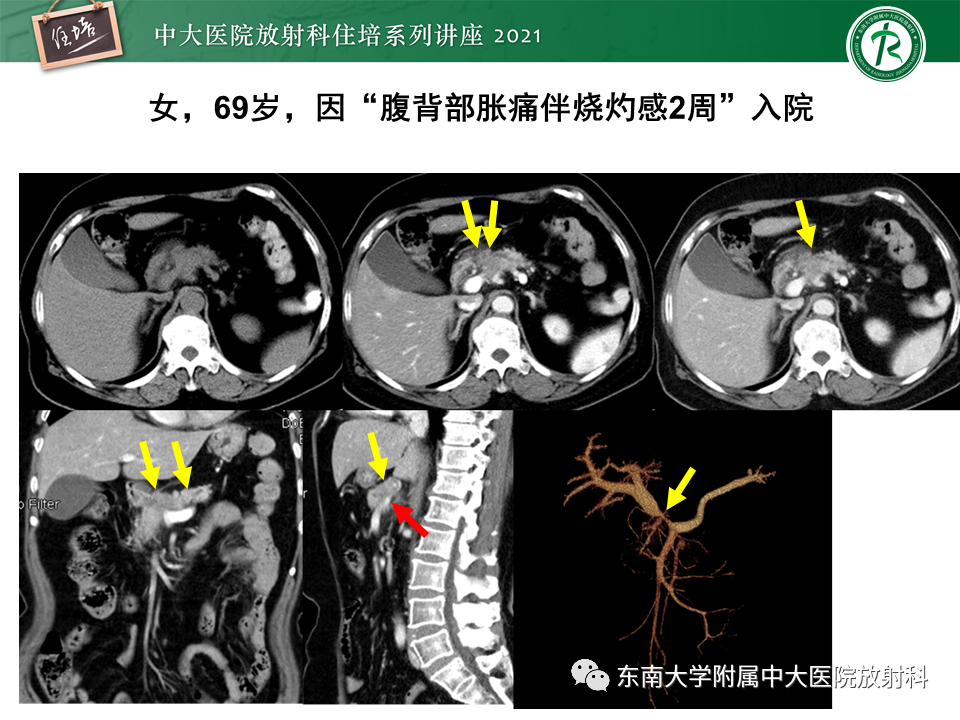 影像PPT - 【PPT】胰腺导管腺癌的影像诊断、评估及鉴别诊断-5