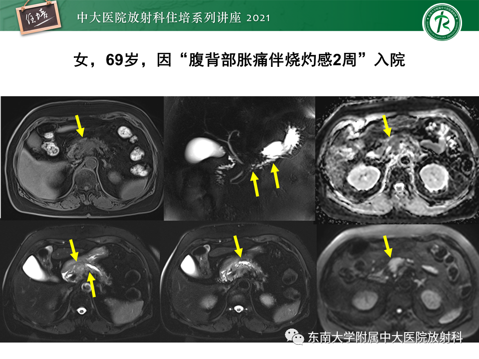 影像PPT - 【PPT】胰腺导管腺癌的影像诊断、评估及鉴别诊断-6