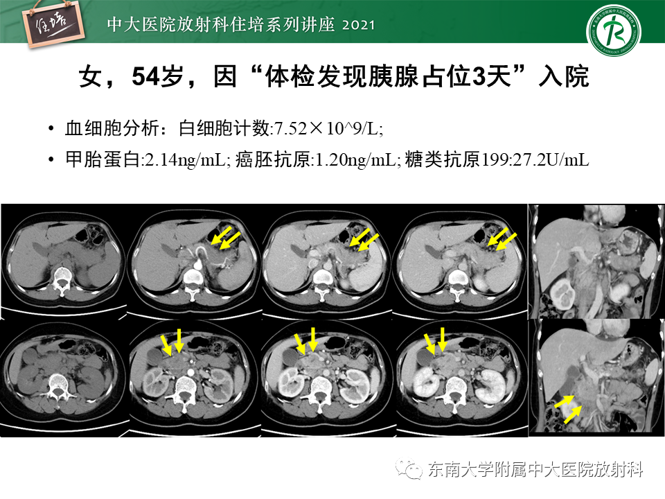 影像PPT - 【PPT】胰腺导管腺癌的影像诊断、评估及鉴别诊断-9