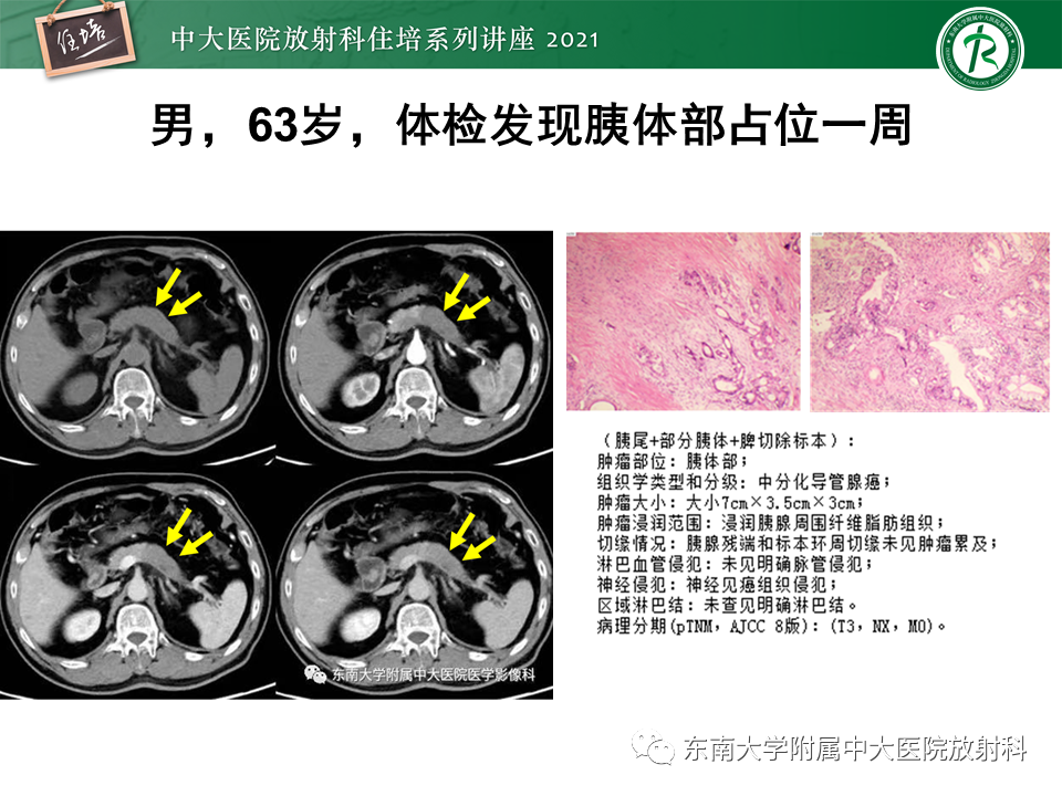 影像PPT - 【PPT】胰腺导管腺癌的影像诊断、评估及鉴别诊断-11