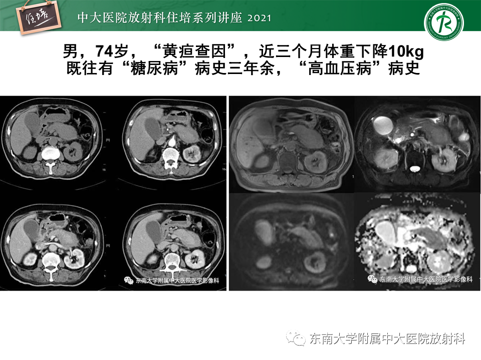 影像PPT - 【PPT】胰腺导管腺癌的影像诊断、评估及鉴别诊断-14