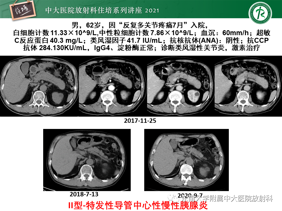 影像PPT - 【PPT】胰腺导管腺癌的影像诊断、评估及鉴别诊断-16