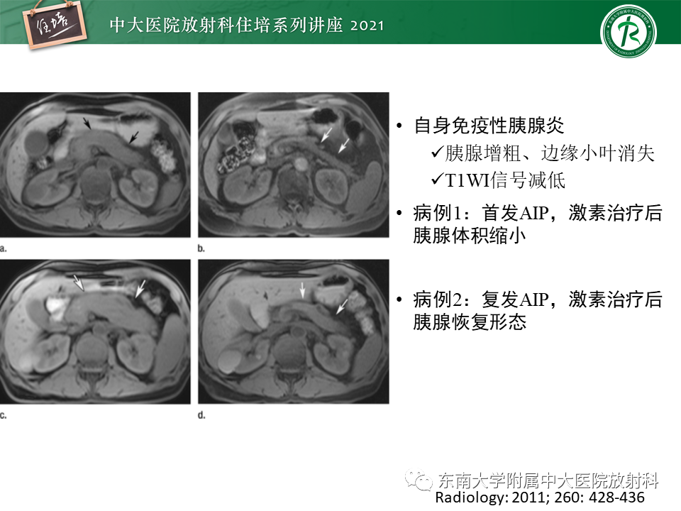 影像PPT - 【PPT】胰腺导管腺癌的影像诊断、评估及鉴别诊断-17