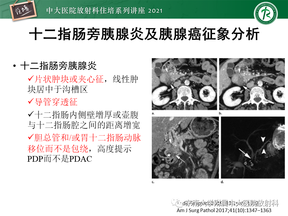 影像PPT - 【PPT】胰腺导管腺癌的影像诊断、评估及鉴别诊断-20