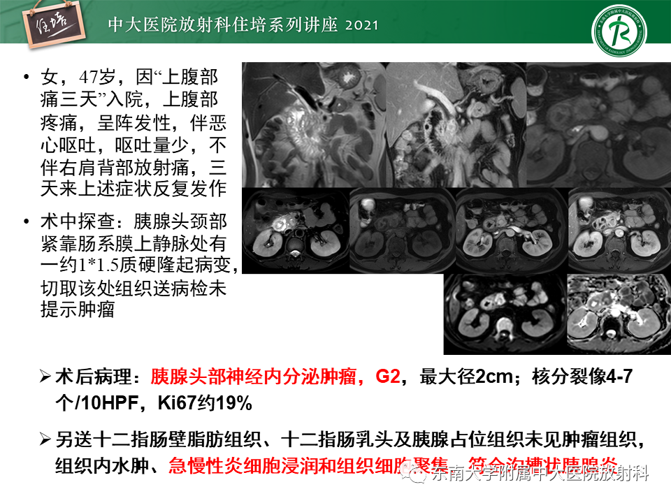 影像PPT - 【PPT】胰腺导管腺癌的影像诊断、评估及鉴别诊断-21