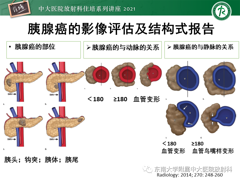 影像PPT - 【PPT】胰腺导管腺癌的影像诊断、评估及鉴别诊断-24