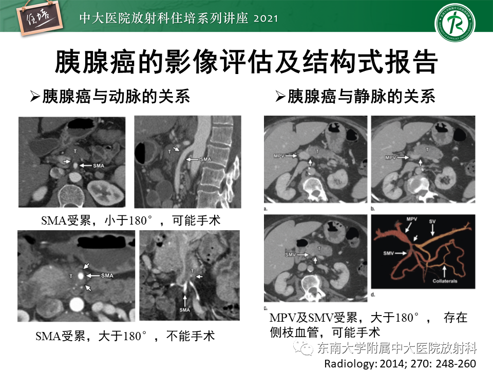 影像PPT - 【PPT】胰腺导管腺癌的影像诊断、评估及鉴别诊断-25