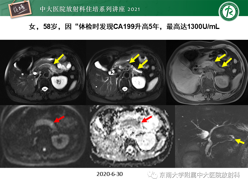 影像PPT - 【PPT】胰腺导管腺癌的影像诊断、评估及鉴别诊断-28
