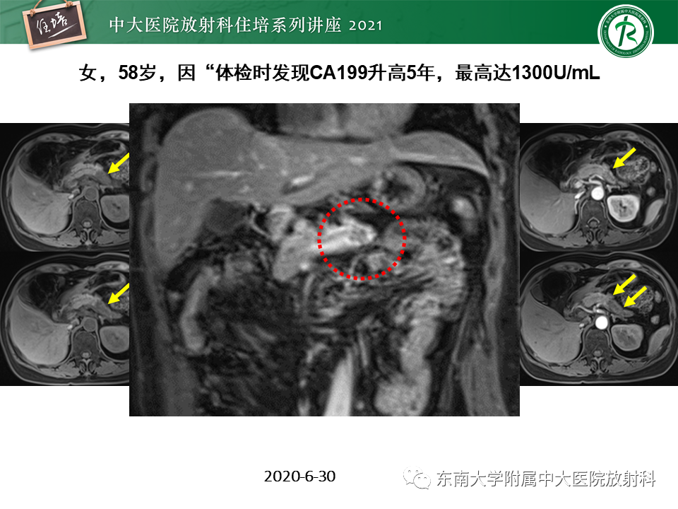 影像PPT - 【PPT】胰腺导管腺癌的影像诊断、评估及鉴别诊断-29