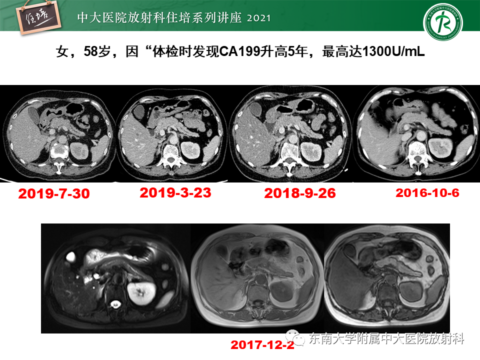 影像PPT - 【PPT】胰腺导管腺癌的影像诊断、评估及鉴别诊断-30