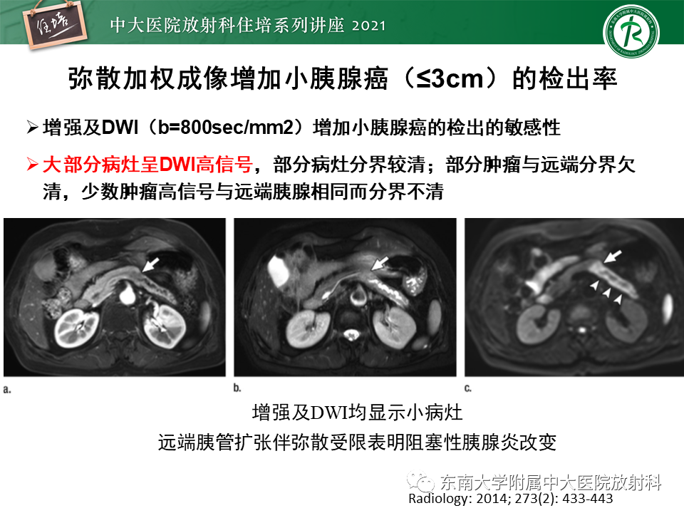 影像PPT - 【PPT】胰腺导管腺癌的影像诊断、评估及鉴别诊断-33