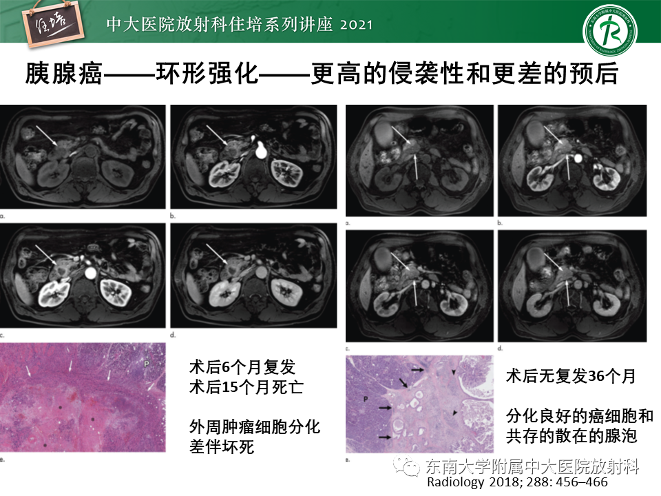 影像PPT - 【PPT】胰腺导管腺癌的影像诊断、评估及鉴别诊断-35