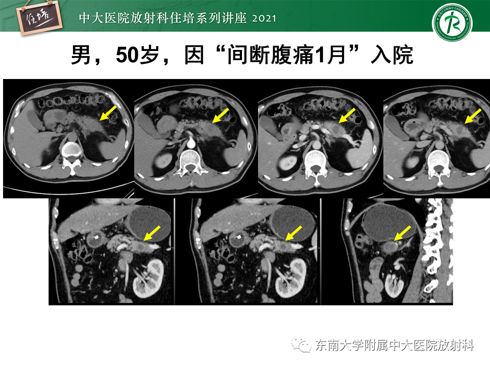 影像PPT - 【PPT】胰腺导管腺癌的影像诊断、评估及鉴别诊断-36