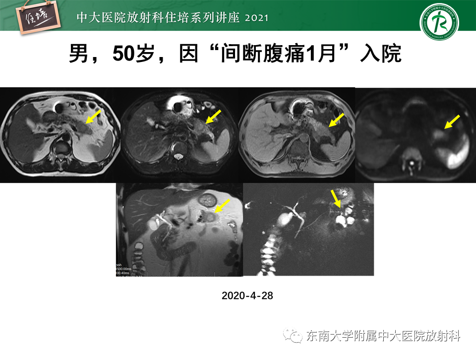 影像PPT - 【PPT】胰腺导管腺癌的影像诊断、评估及鉴别诊断-37