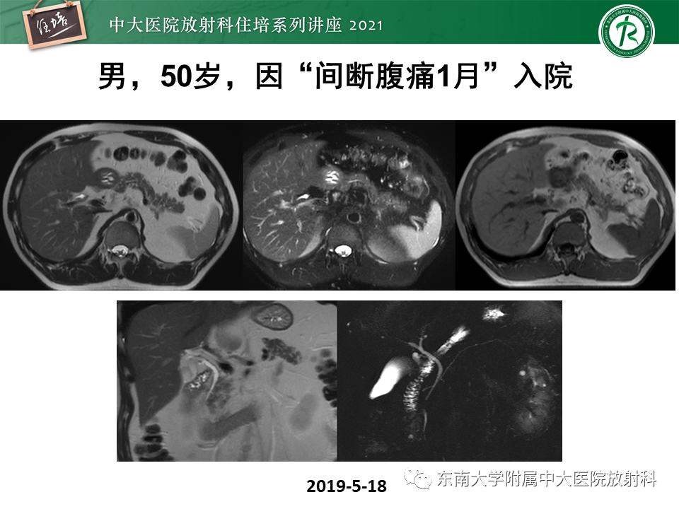 影像PPT - 【PPT】胰腺导管腺癌的影像诊断、评估及鉴别诊断-38