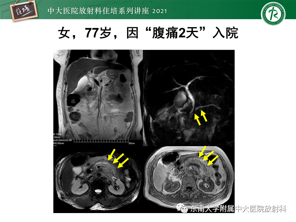 影像PPT - 【PPT】胰腺导管腺癌的影像诊断、评估及鉴别诊断-42