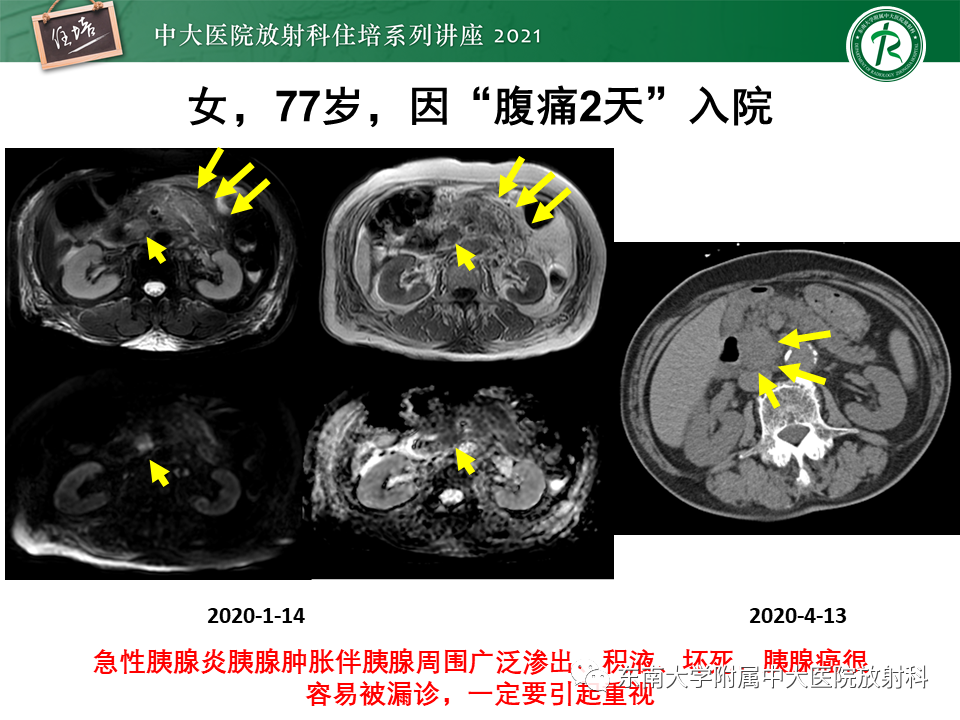 影像PPT - 【PPT】胰腺导管腺癌的影像诊断、评估及鉴别诊断-43